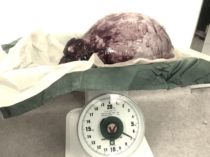 Khối u tử cung 12 kg khiến người phụ nữ như mang bầu